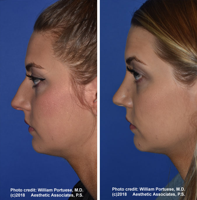 Rhinoplasty Recovery