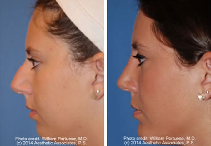 Rhinoplasty Recovery