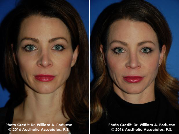 Rhinoplasty Recovery